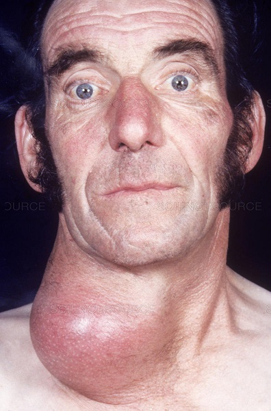 man with goiter - Copy